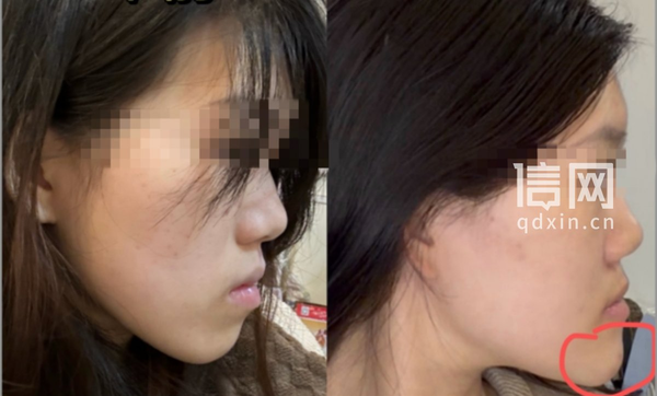 24 岁女孩正颌手术被做反，变成「鞋拔子脸」，武汉卫健部门介入，医院和医生各得担哪些责？女孩还能恢复吗？