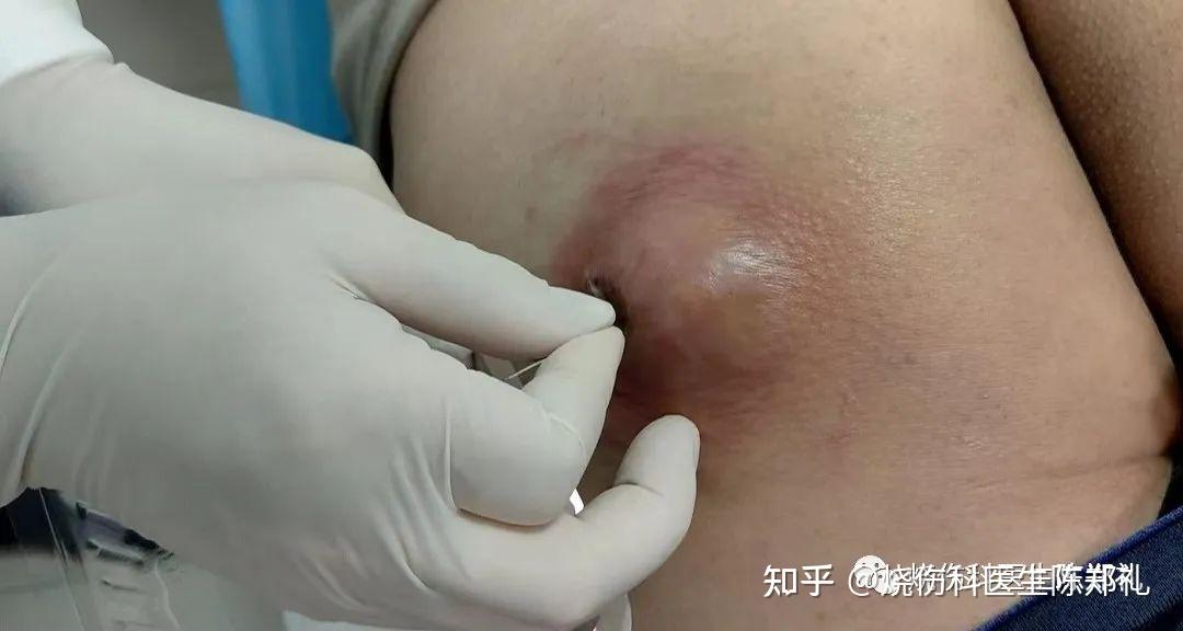 为什么火疖子切开引流后，要塞填充物进去?